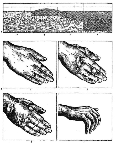 Оказание первой помощи при ожогах и порезах