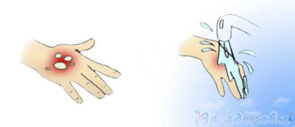 Химический ожог пвторойстепени