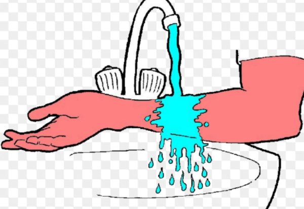 Степени ожогов термические 1 степень