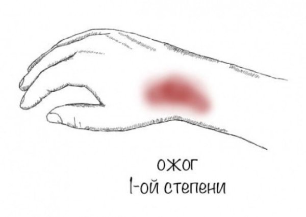 Первая помощь при термических ожогах