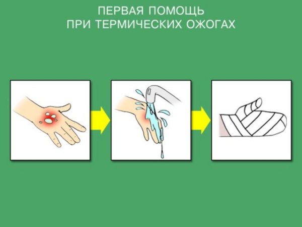 Термические ожоги жидкостью