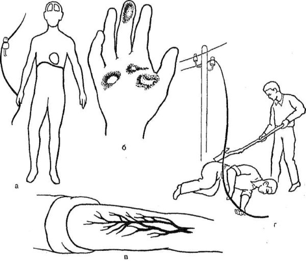 Термические и химические ожоги
