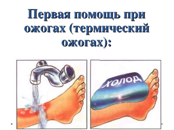 Первая помощь при ожогах схема