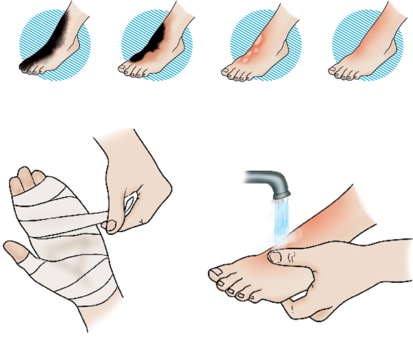 Алгоритм оказания первой медицинской помощи при химических ожогах