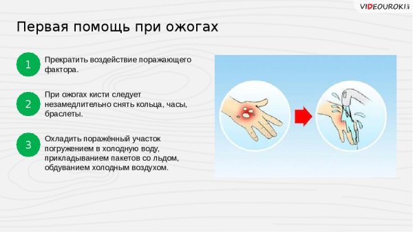 Первая помощь при ожоге 1 степени