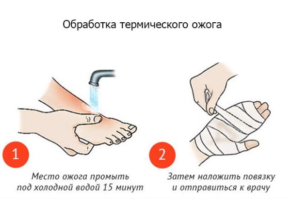 ПМП при ожоге кипятком