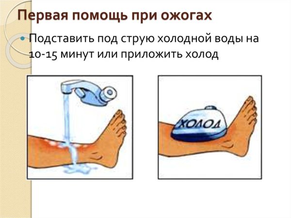 Оказание первой помощи при ожоге для детей
