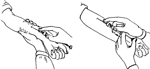 Постинъекционные осложнения внутрикожных инъекций