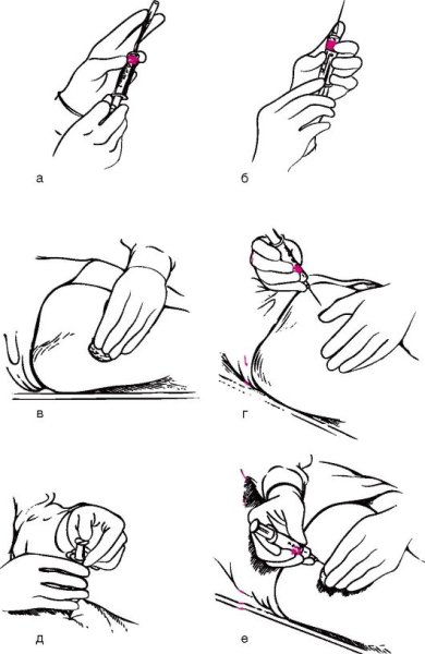 Техника внутримышечной инъекции алгоритм