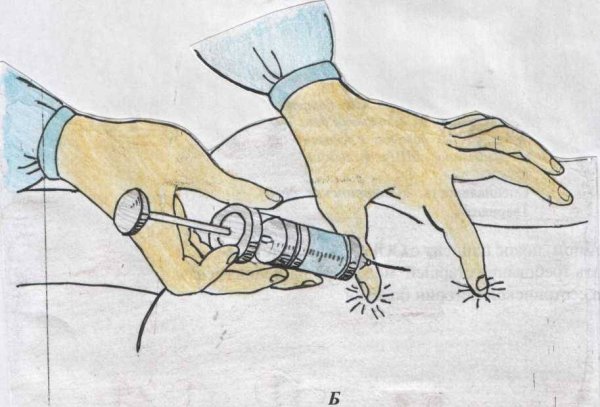 Внутримышечная инъекция техника выполнения