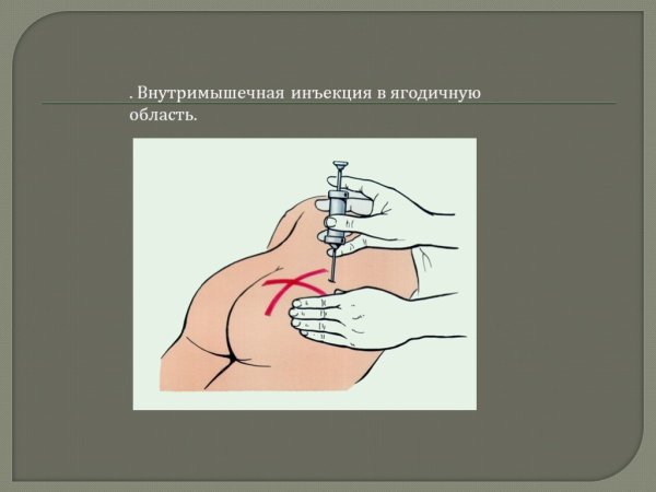 Техника введения внутримышечной инъекции в ягодицу