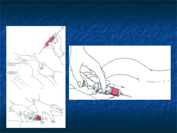 Глубокий внутримышечный укол