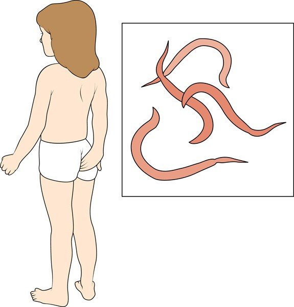 Энтеробиоз острицы у детей