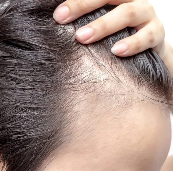 Рубцовая алопеция классификация