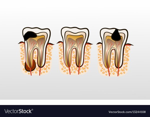 Кариес зубов картинки для детей