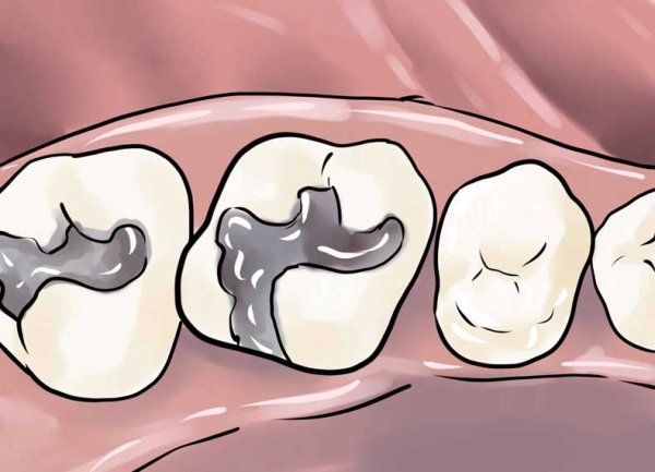Зуб с кариесом раскраска