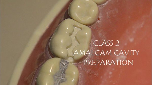 Пломба из амальгамы в СПБ