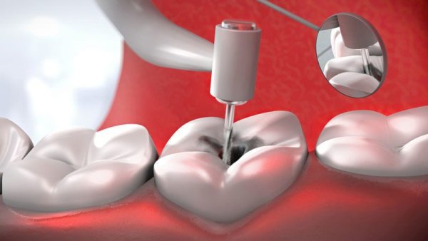 Разделитель зуботехника