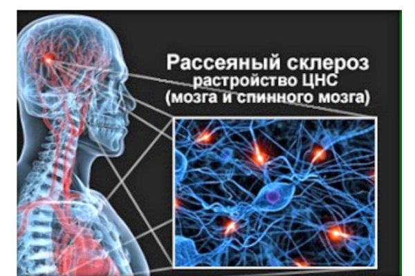 Рассеянный склероз символ