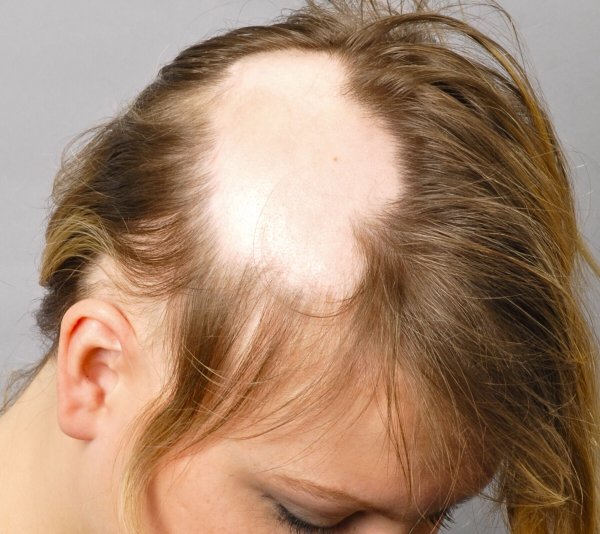 Атрофическая алопеция