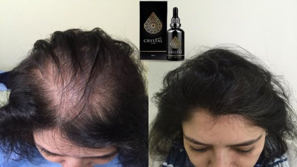 Экозависимая алопеция