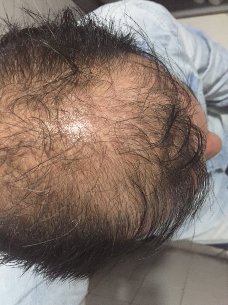 Облысение у женщин