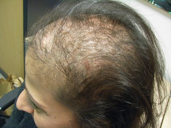 Редкие волосы на макушке