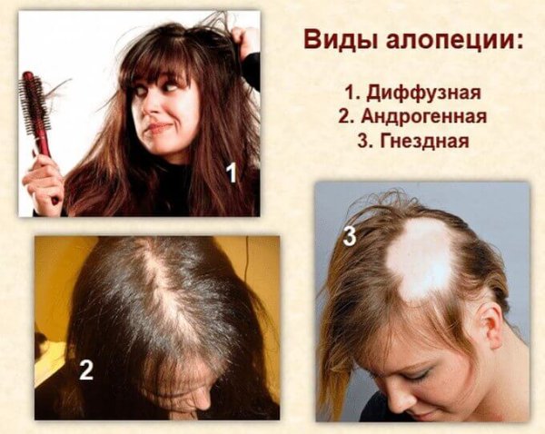 Поредение волос на голове