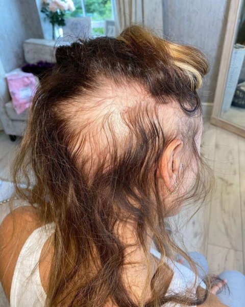 Аппарат для пересадки волос