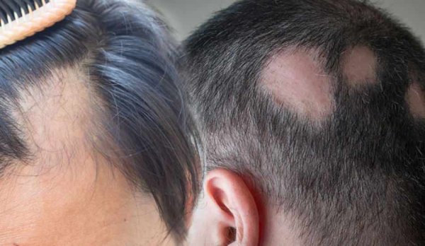 Миноксидил Генеролон 5