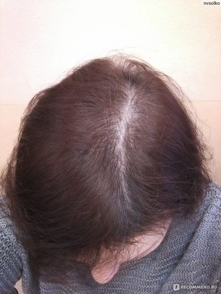 Субтотальная алопеция у детей