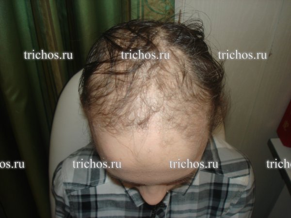 Андрогенетическая алопеция