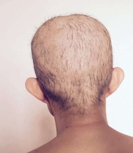 Очаговая алопеция лентовидная