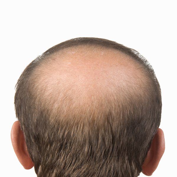 Маленькая лысина на голове