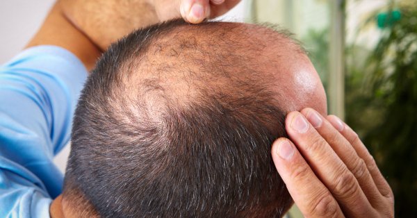 Симптоматическая алопеция