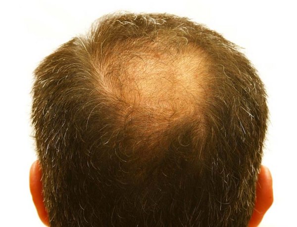 Сыпятся волосы