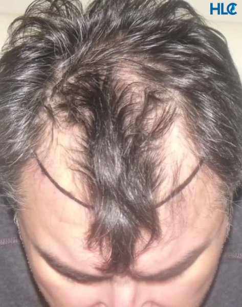 Первичная рубцовая алопеция