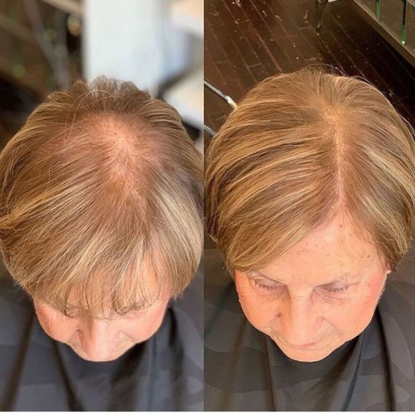 Андрогензависимая алопеция