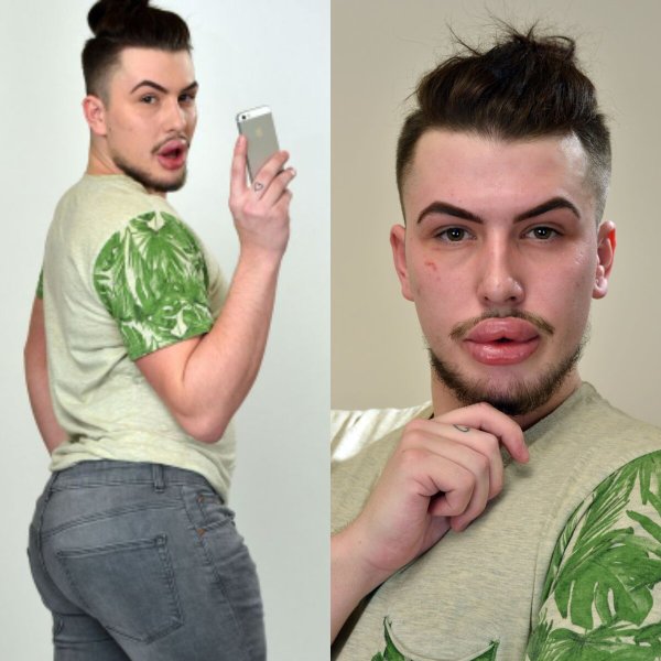 Огромные губы с ботоксом