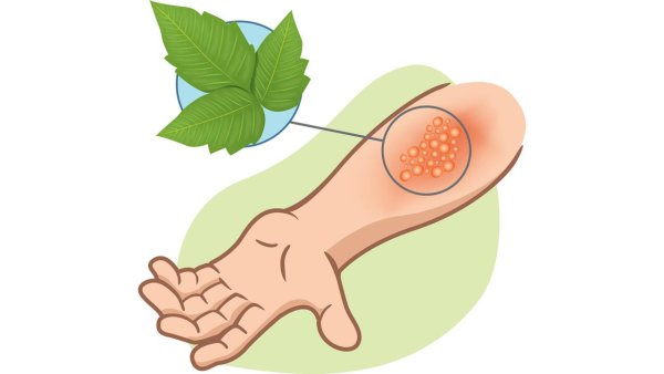 Кожные заболевания рисунки