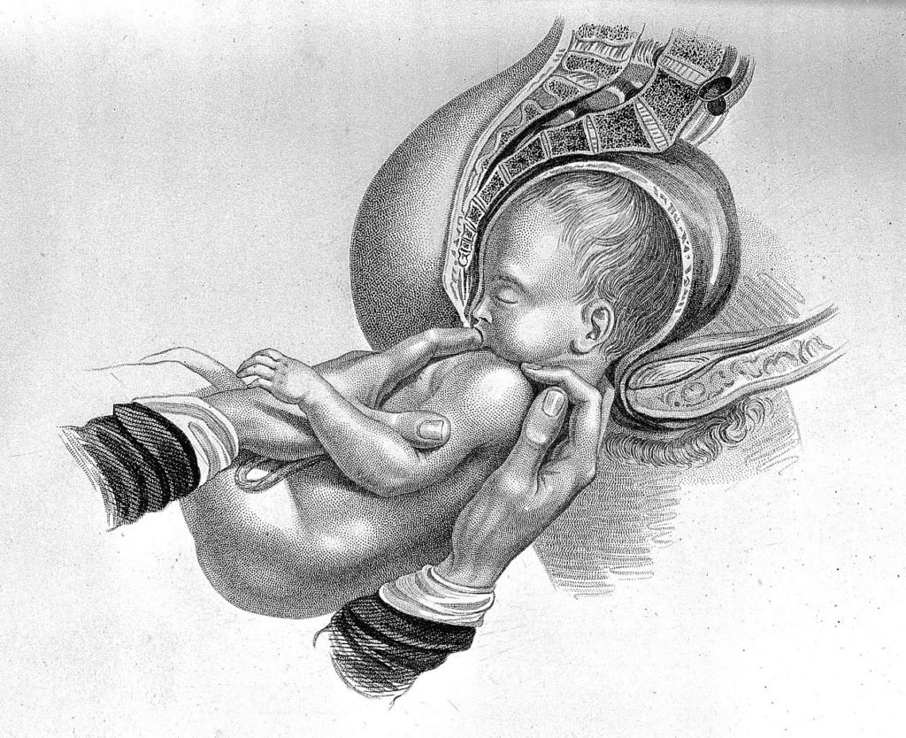 Рождение ребенка в тазовом предлежании