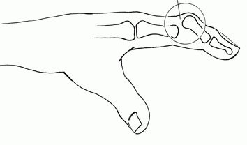 Вывих сустава первая помощь