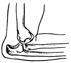 Схема вывиха и подвывиха сустава