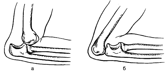 Вывих коленного сустава схема