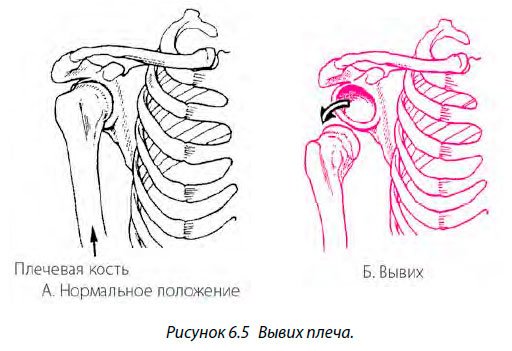 Подвывих плечевого сустава