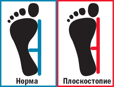 Плантограмма продольное плоскостопие