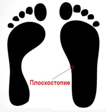 Плоскостопие вид сбоку