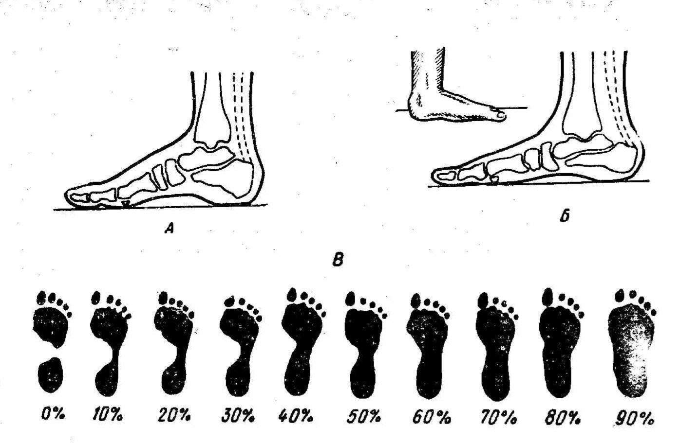 Как выглядит стопа при плоскостопии 3 степени фото ног