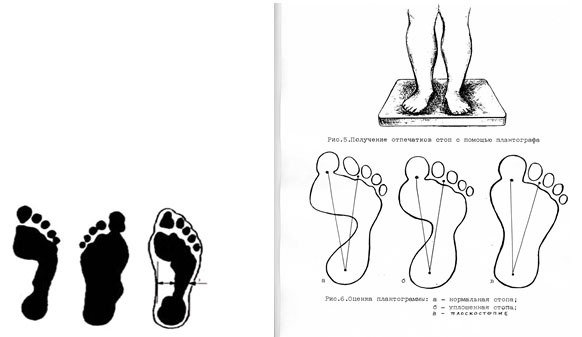 Рисунок плоскостопия (43 фото)