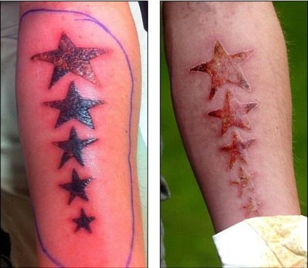 Химический ожог Татуировки